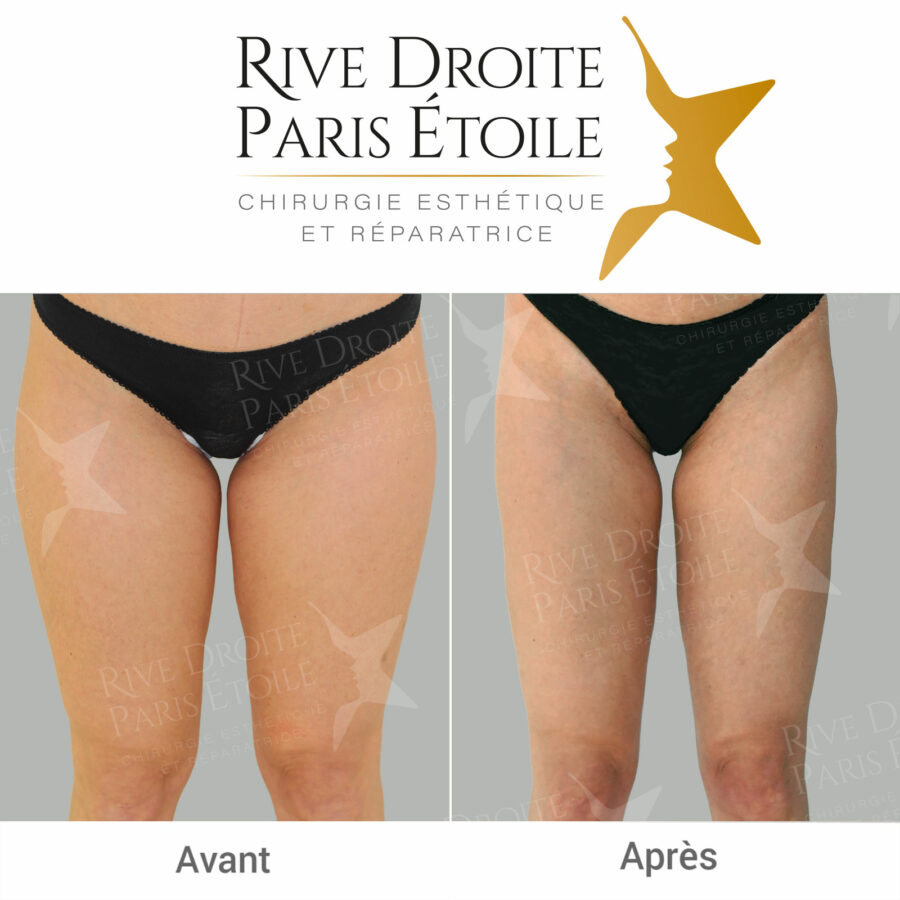 before and after thigh liposuction in Paris
