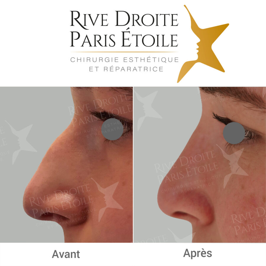 before and after rhinoplasty in Paris