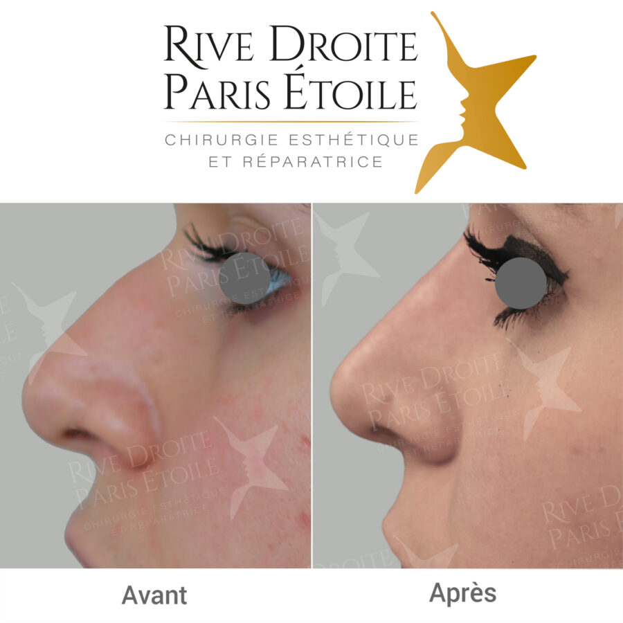 before and after non-surgical rhinoplasty in Paris
