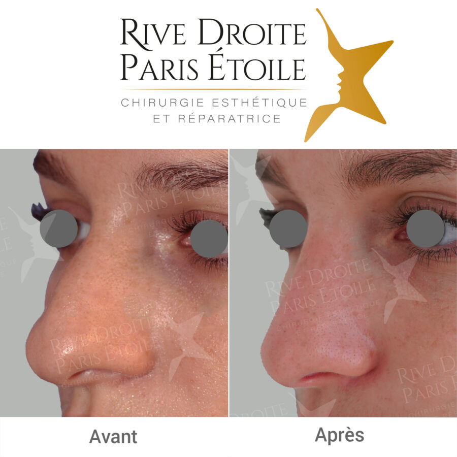 before and after rhinoplasty in Paris