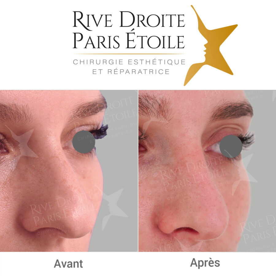 before and after rhinoplasty in Paris