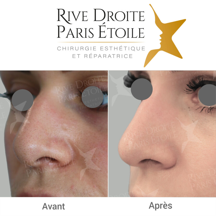 before and after non-surgical rhinoplasty in Paris