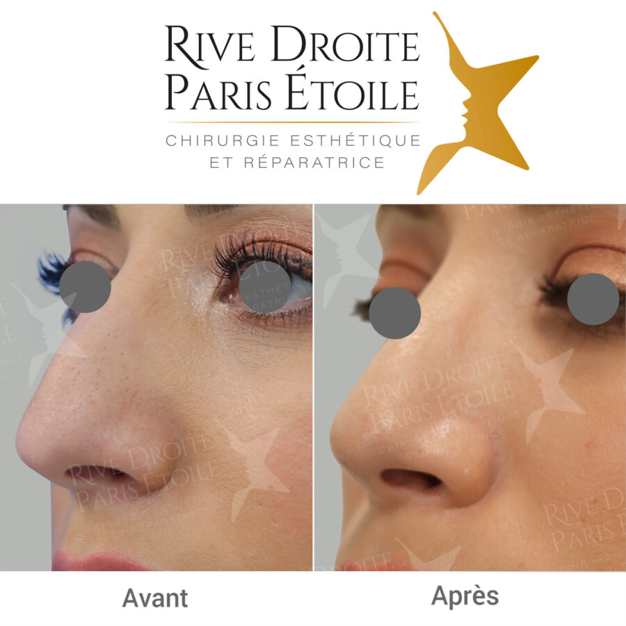 Rhinoplasty in Paris — before / after result of a closed rhinoplasty at 4.5 months