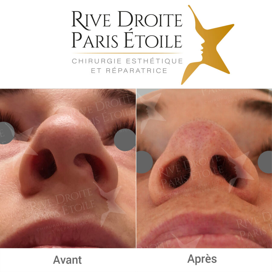 before and after rhinoplasty in Paris