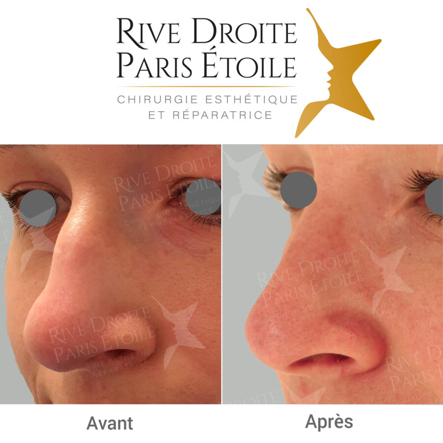 before and after rhinoplasty in Paris