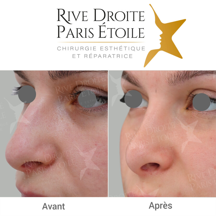 before and after rhinoplasty in Paris