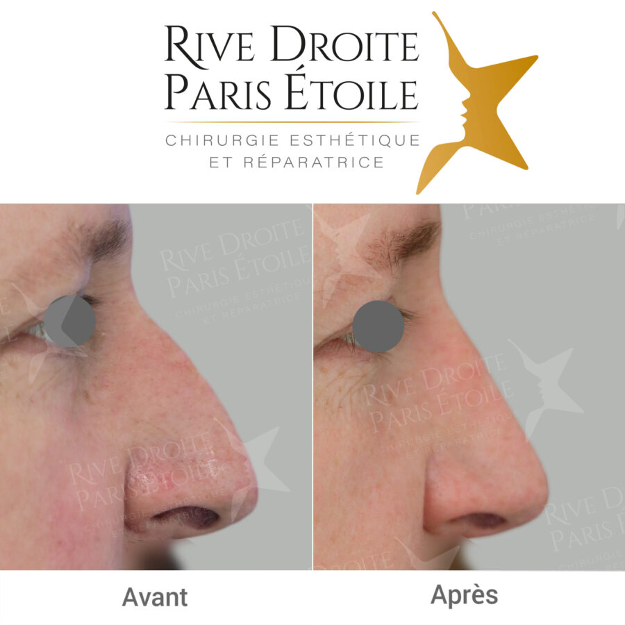before and after rhinoplasty in Paris