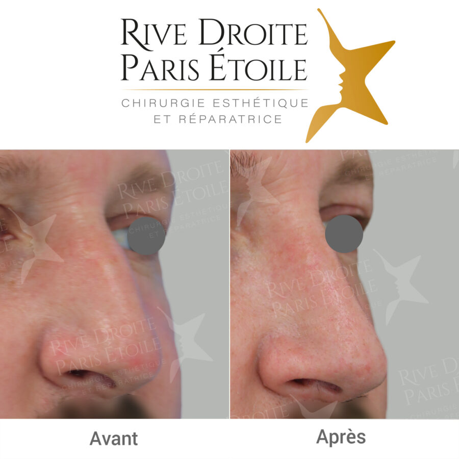 before and after rhinoplasty in Paris