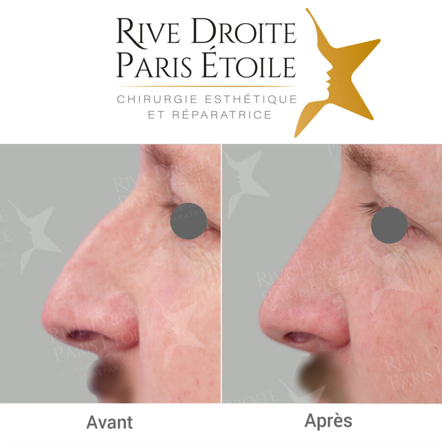 before and after rhinoplasty in Paris
