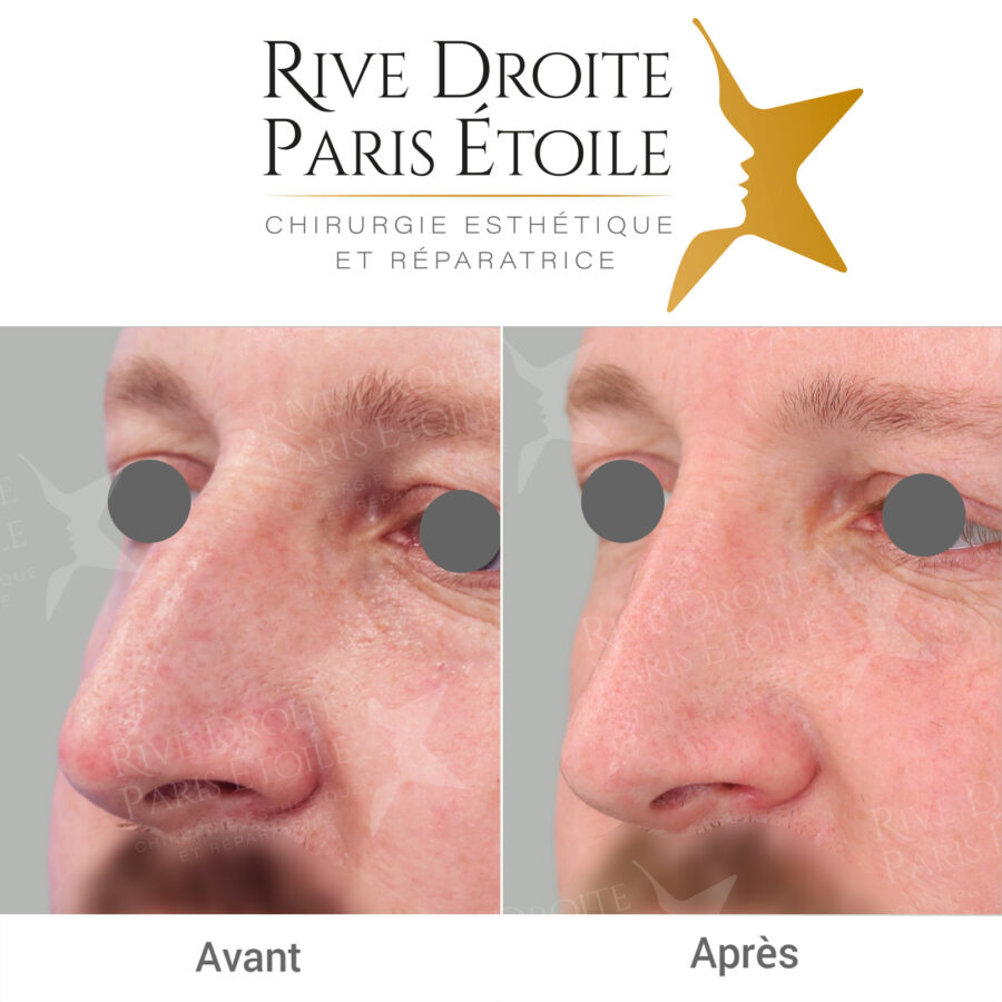 before and after rhinoplasty in Paris