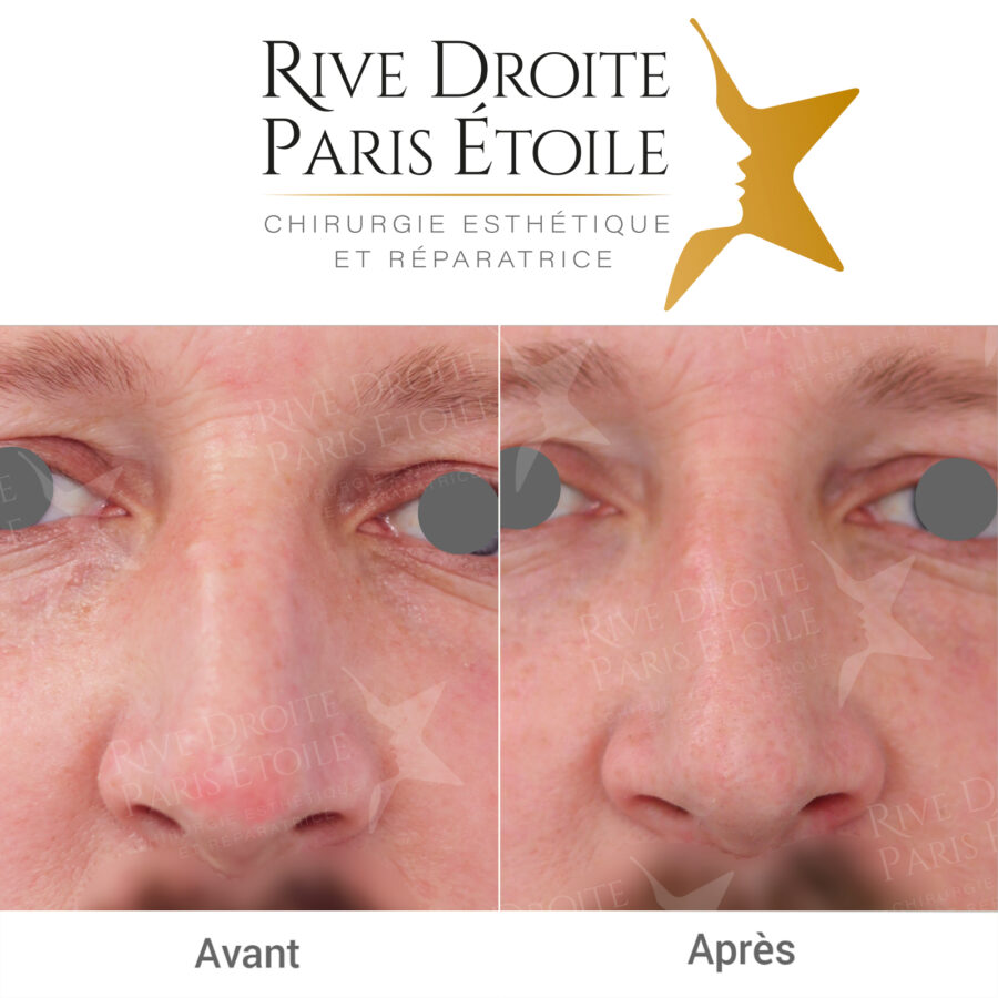 before and after rhinoplasty in Paris
