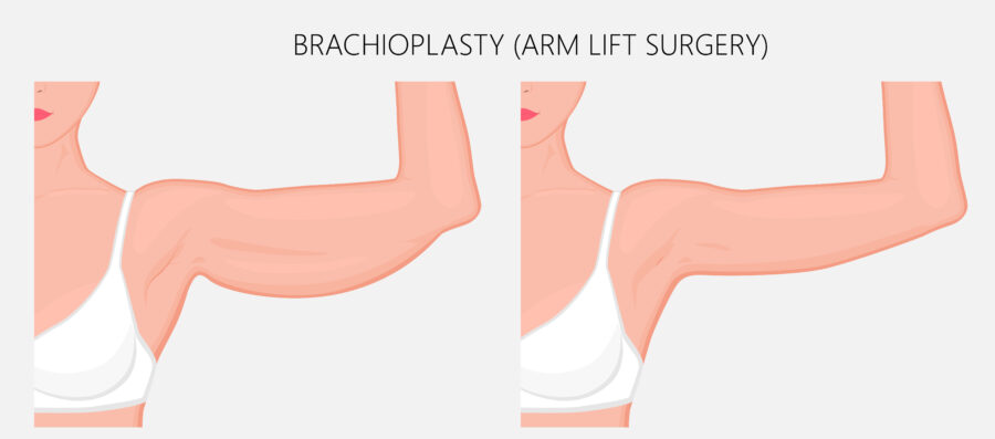 Brachioplastie ou lifting des bras