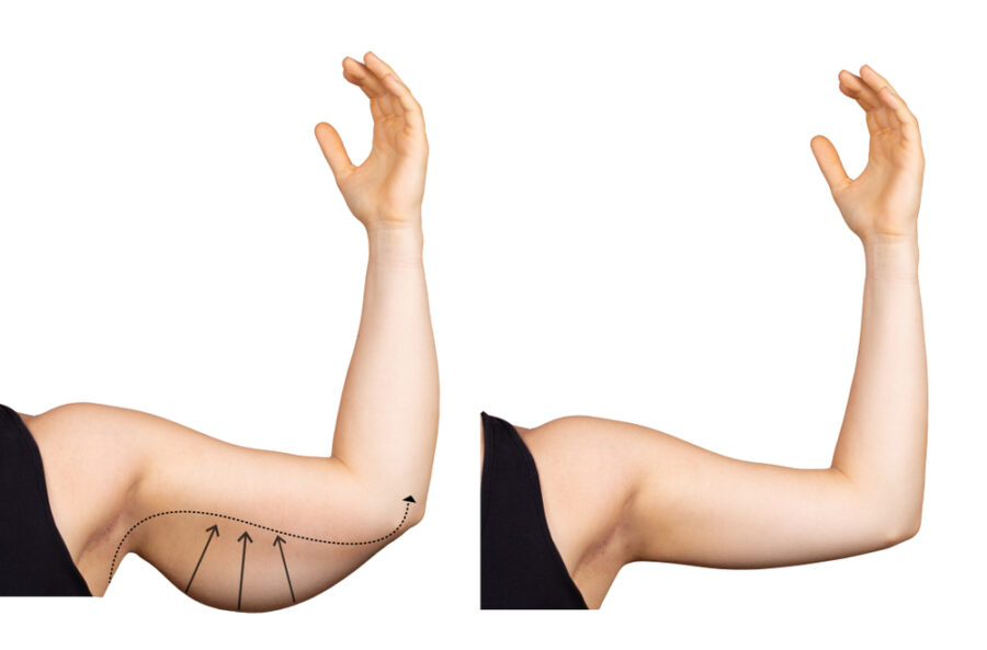 Lifting des bras