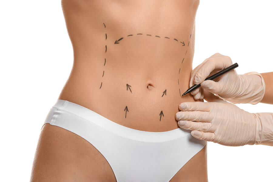 Liposuccion 4D