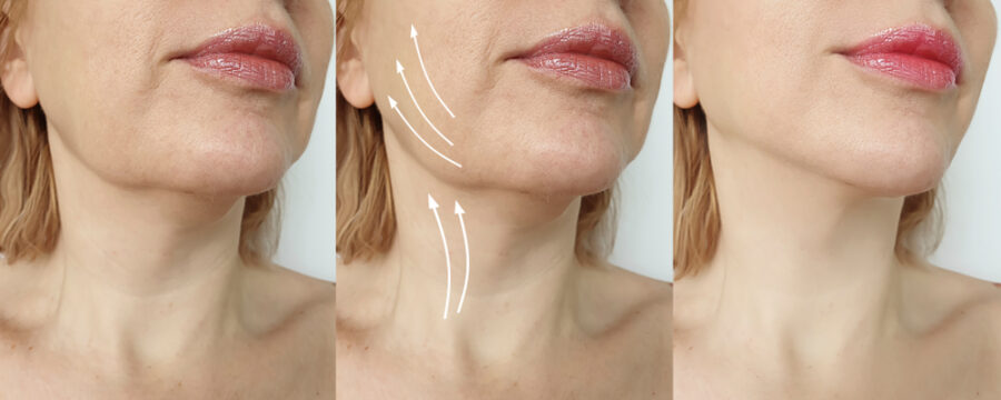 Relachement cutané zones du visage