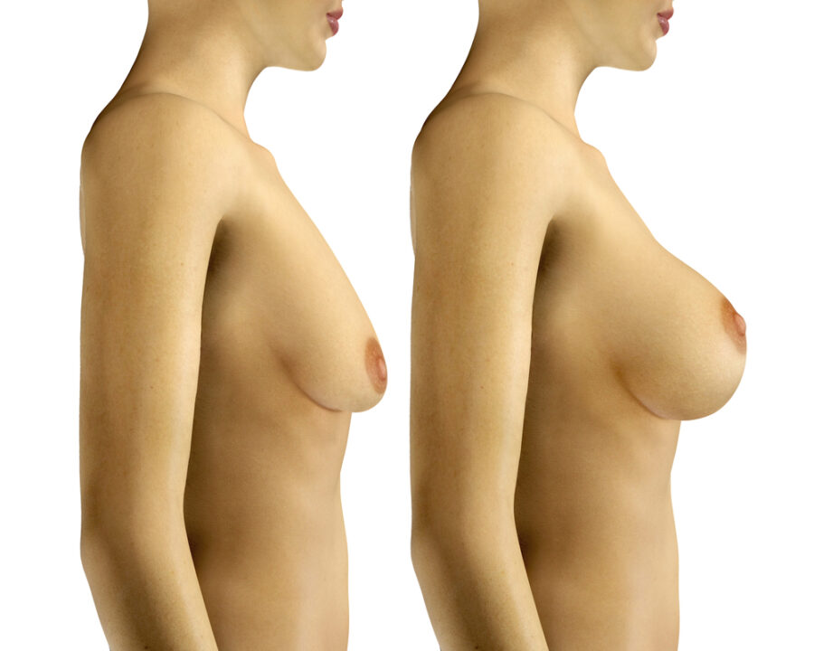 Augmentation mammaire par implants