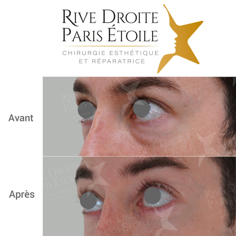 before and after blepharoplasty (eyelid surgery) in Paris