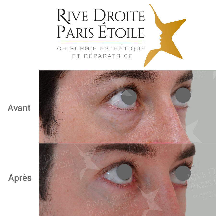 before and after blepharoplasty (eyelid surgery) in Paris