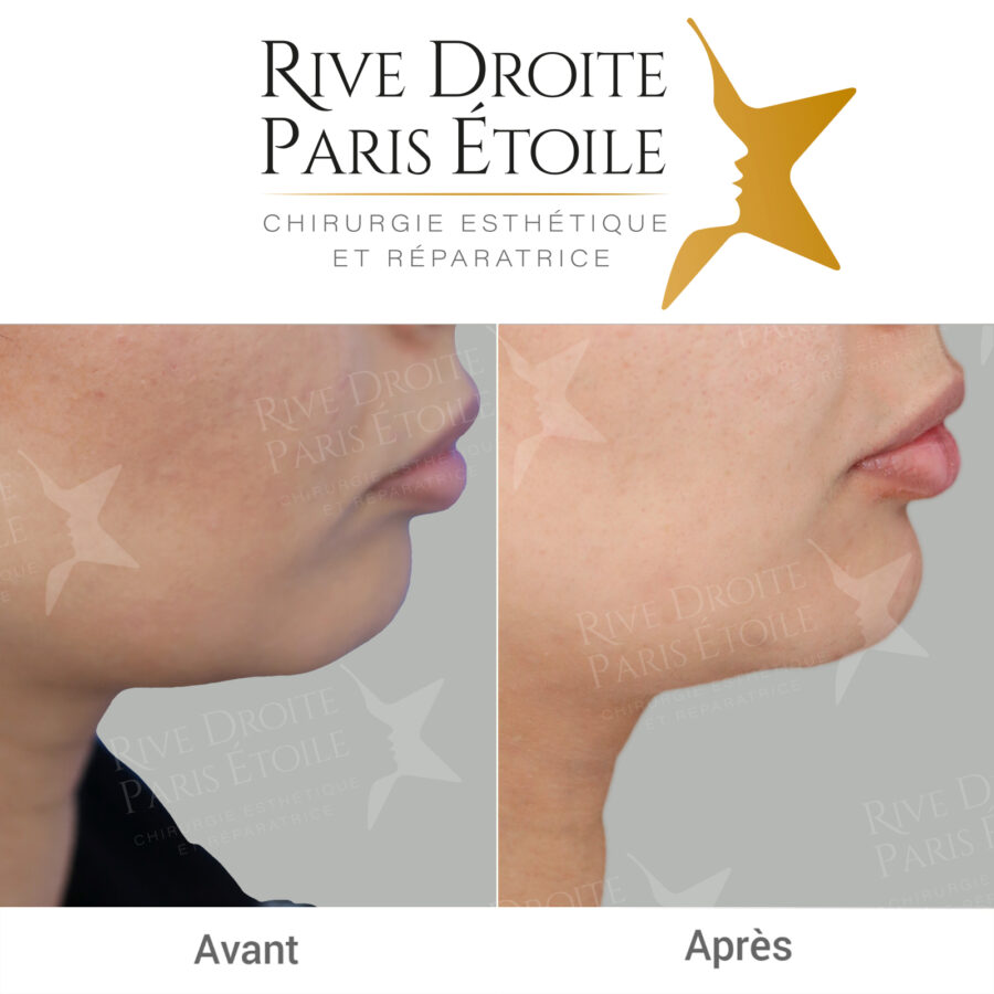 before and after non-surgical chin augmentation in Paris