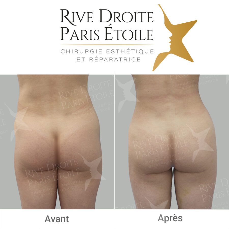 before and after buttock lipofilling in Paris