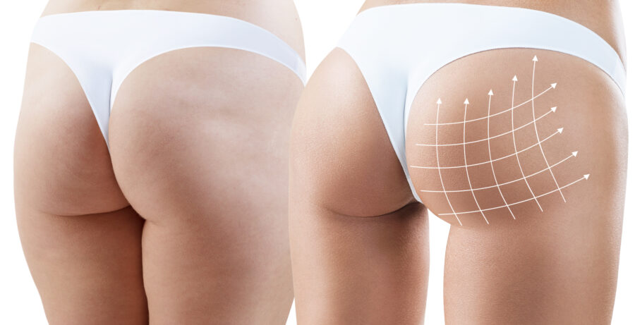 Lipofilling fessier contre la cellulite