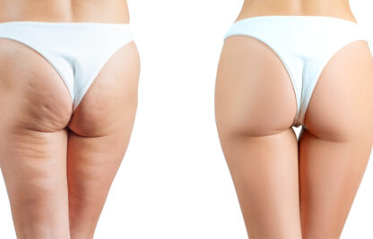 Se débarrasser de la cellulite des fesses