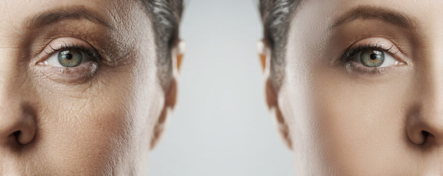 Lifting cervico-facial