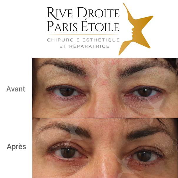 Blépharoplastie supérieure et inférieure à un an