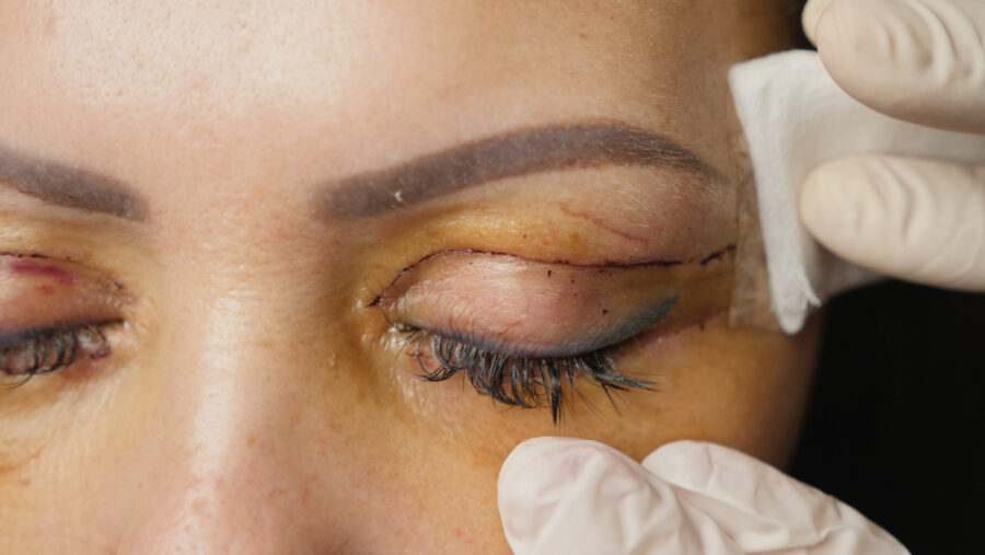 Convalescence blépharoplastie