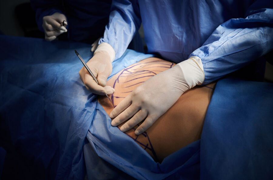Intervention abdominoplastie