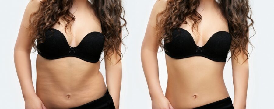 Résultats abdominoplastie