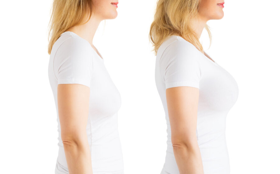Augmentation mammaire hypoplasie