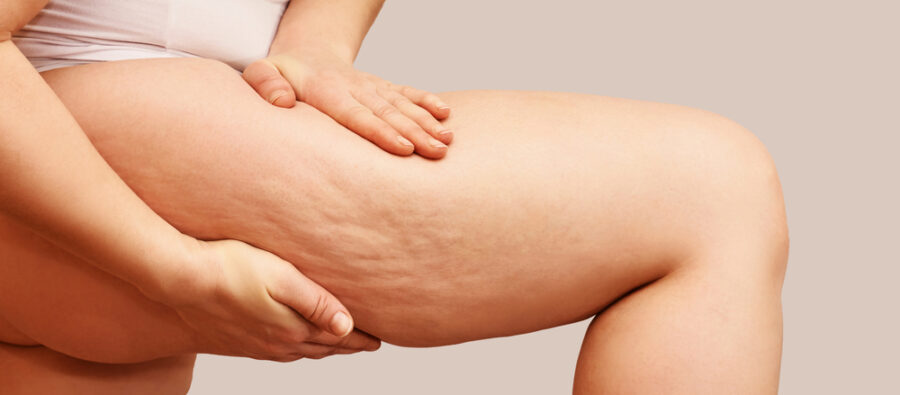 Cellulite cuisse