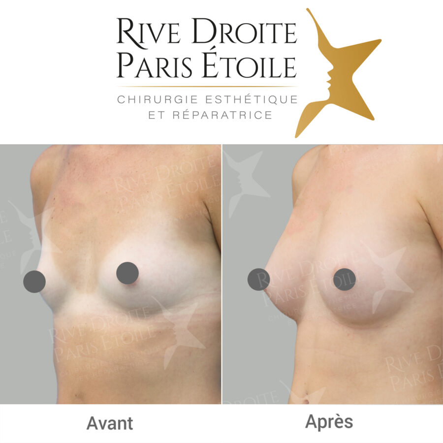 before and after breast lipofilling in Paris