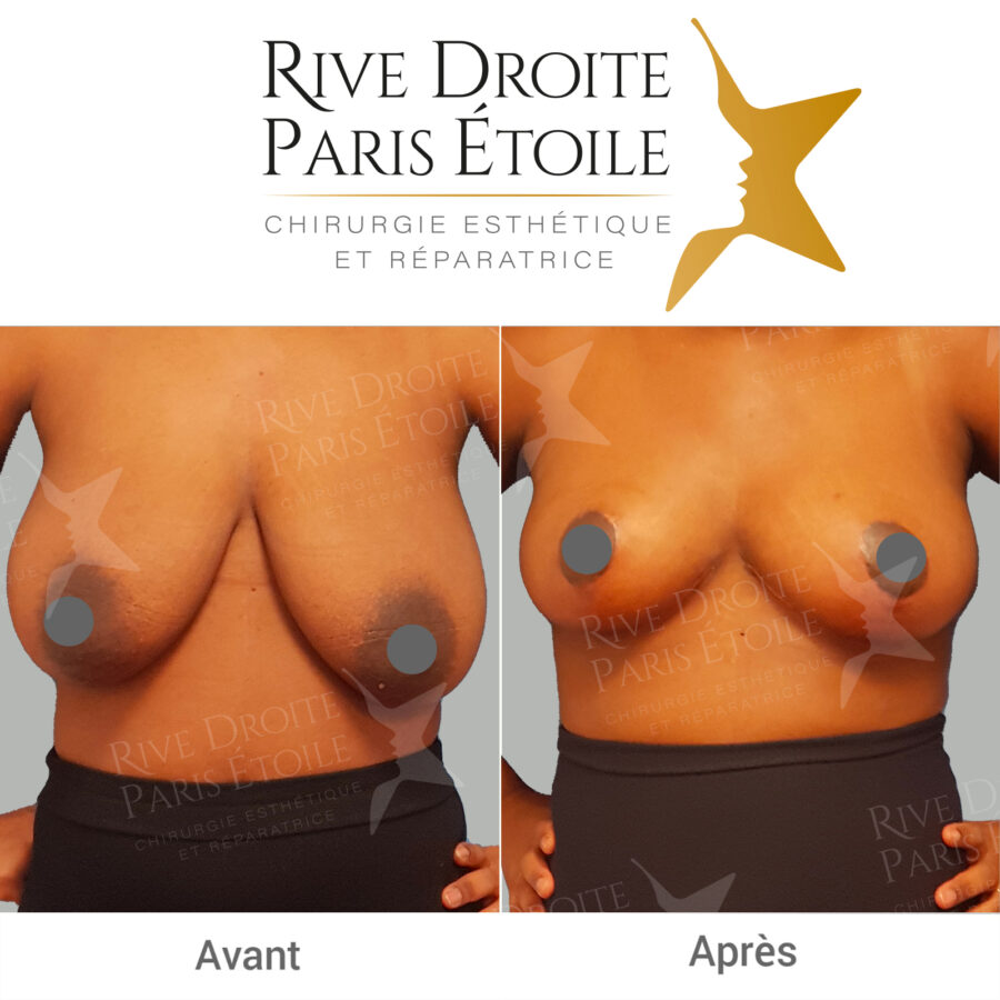 before and after breast reduction in Paris