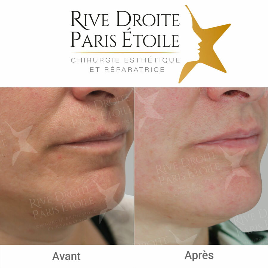 before and after non-surgical facelift in Paris