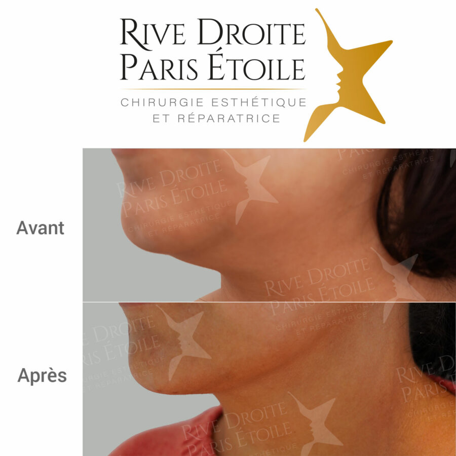 before and after neck and double chin liposuction in Paris