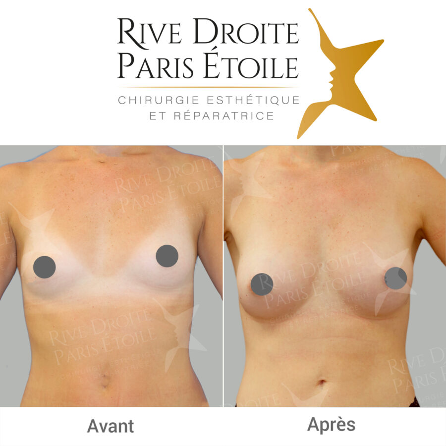 before and after breast lipofilling in Paris