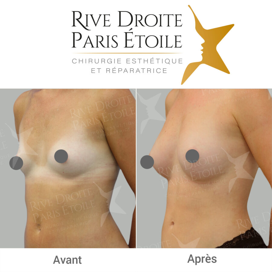 before and after breast lipofilling in Paris
