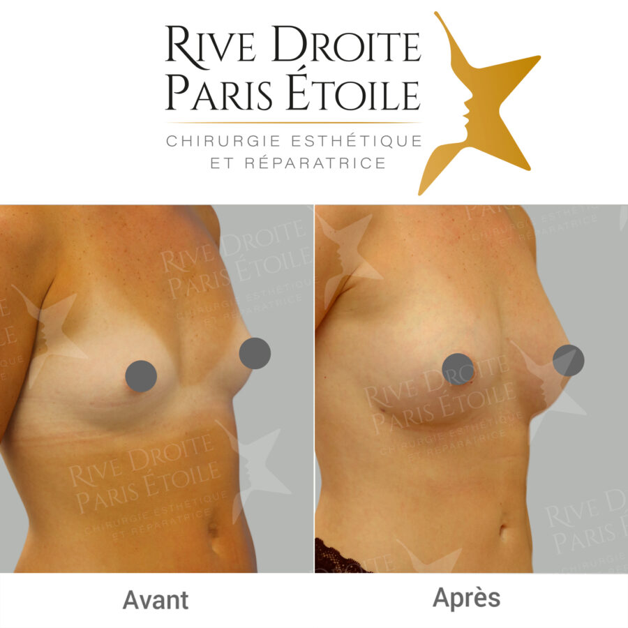 before and after breast lipofilling in Paris