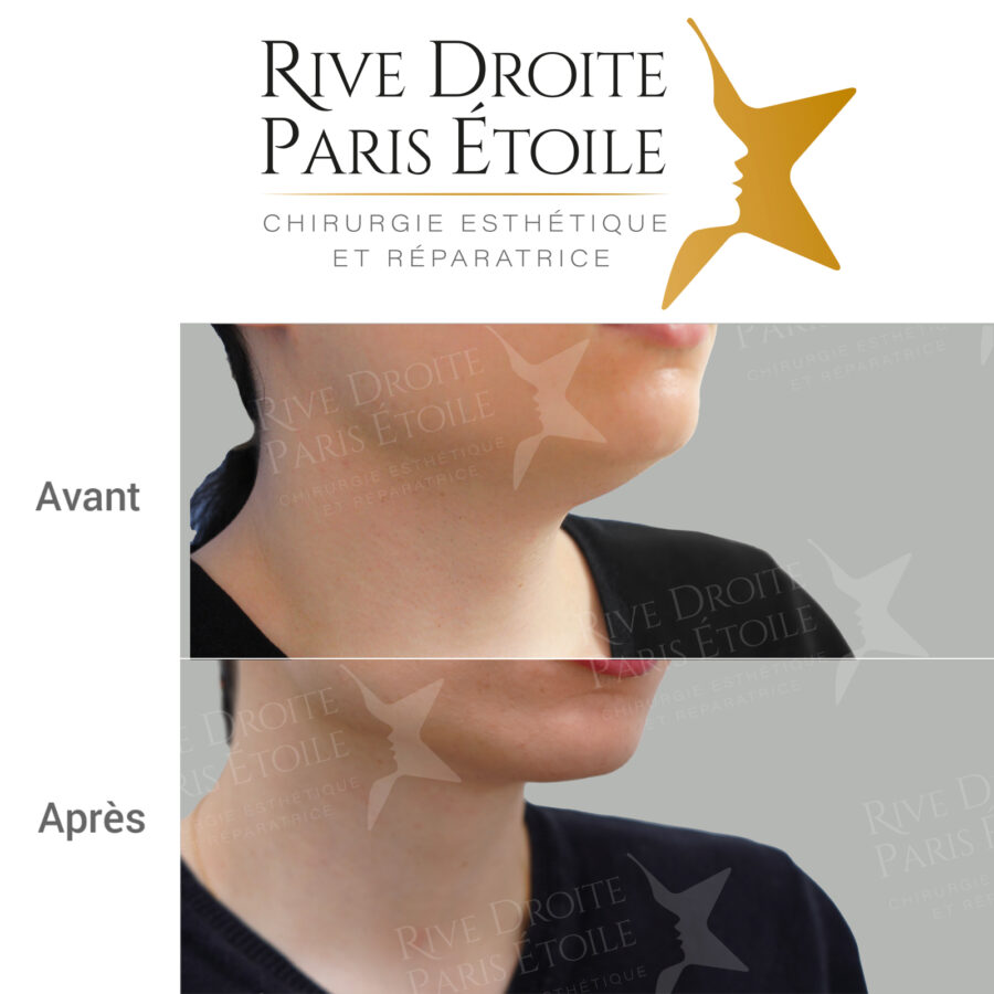 before and after neck and double chin liposuction in Paris