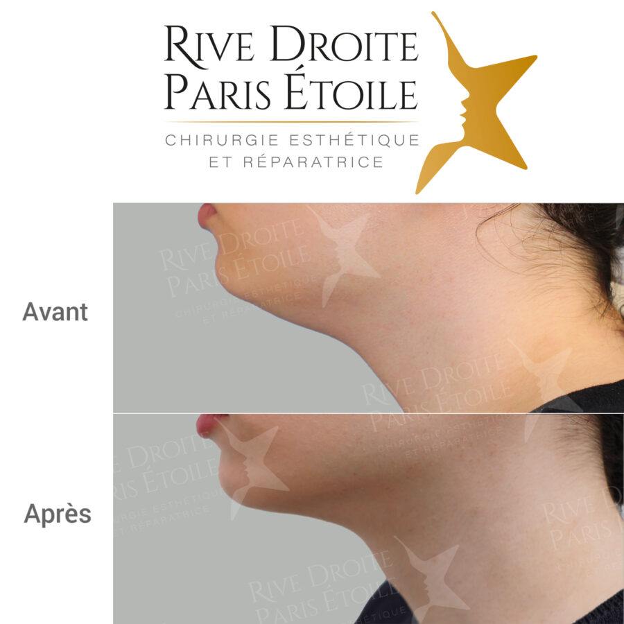 before and after neck and double chin liposuction in Paris