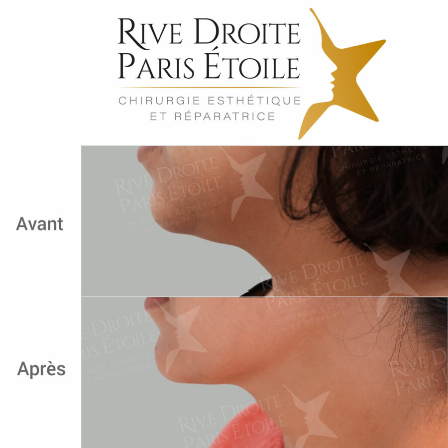 before and after neck and double chin liposuction in Paris