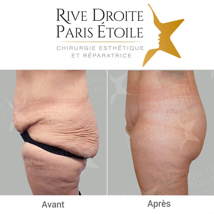 before and after bodylift in Paris