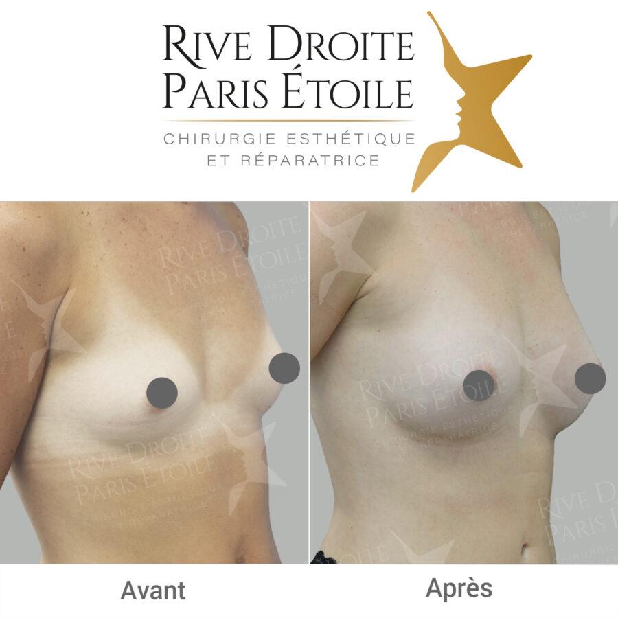 before and after breast lipofilling in Paris