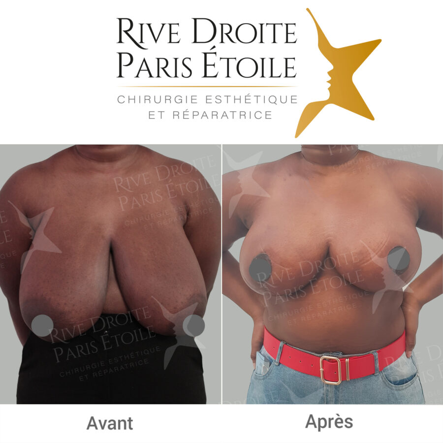 before and after breast reduction in Paris