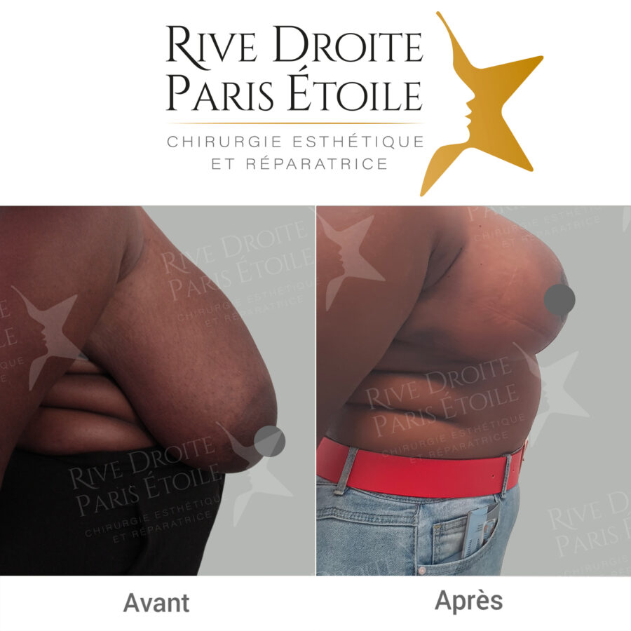 before and after breast reduction in Paris