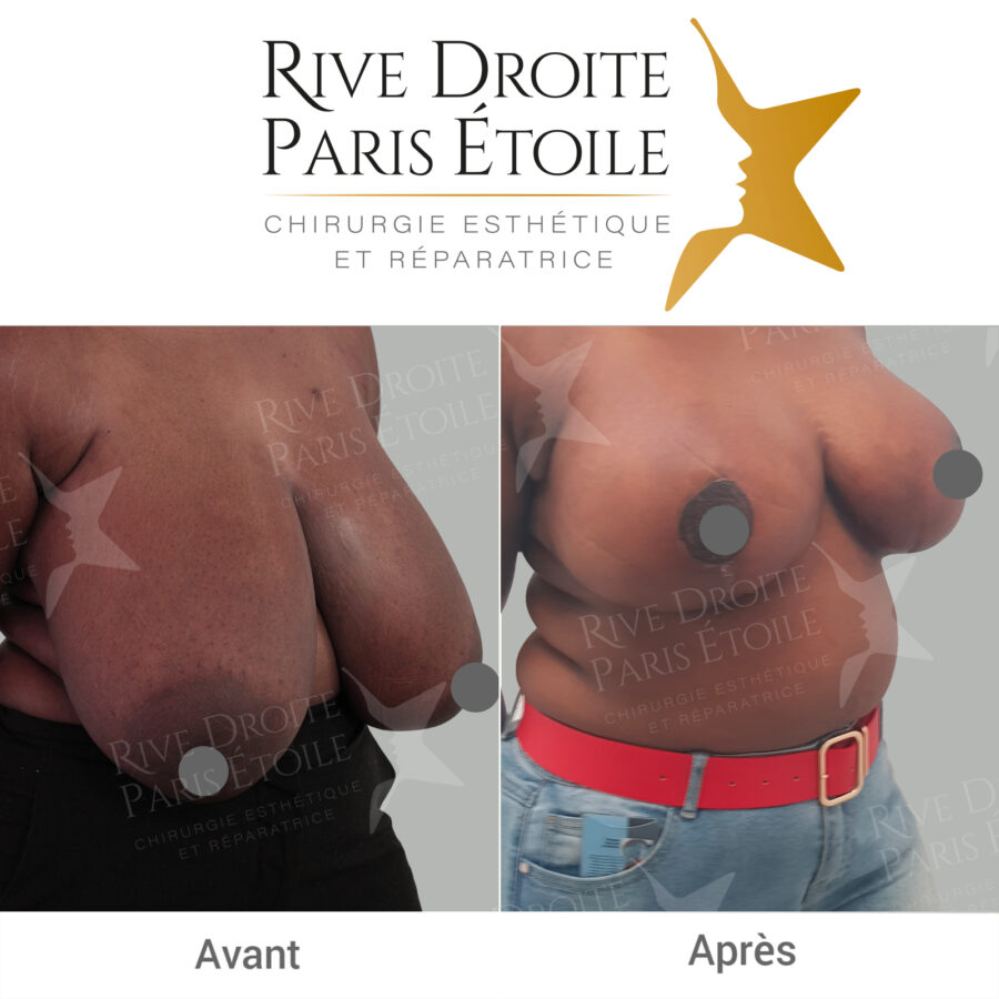 before and after breast reduction in Paris