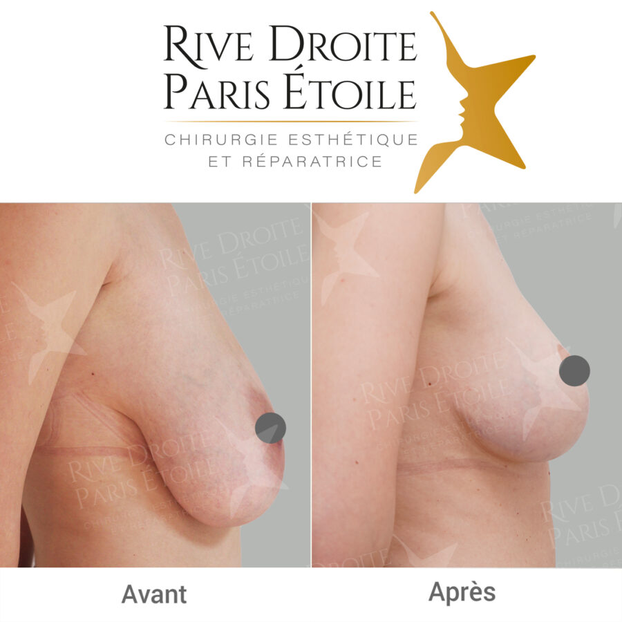 before and after breast reduction in Paris