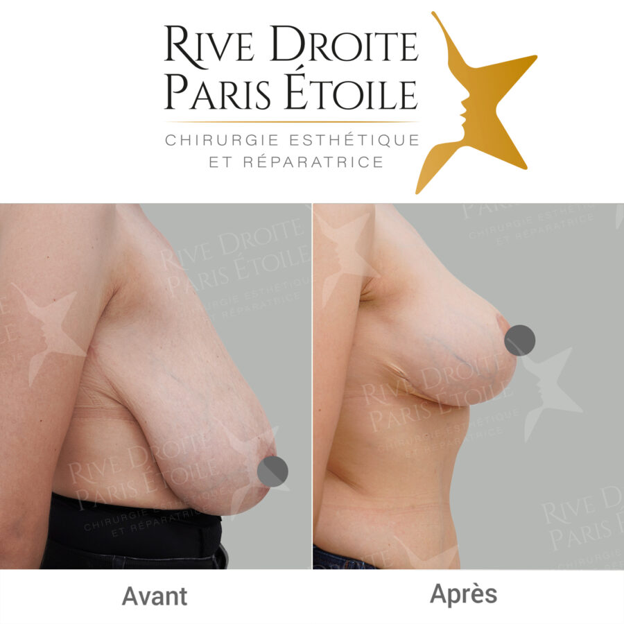 Breast reduction in Paris — before / after photo of a breast reduction (500 g / 425 g)